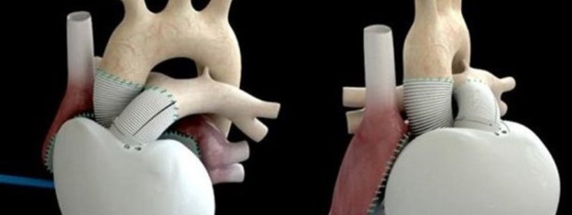 Искусственное сердце